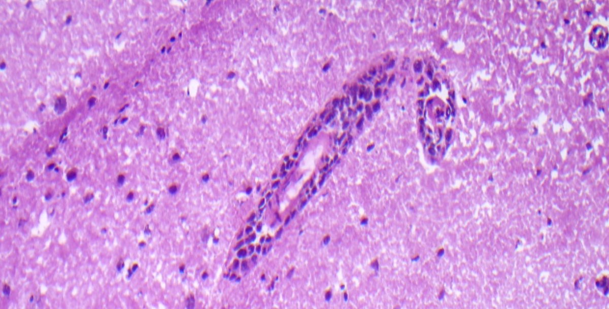 TuftsMCPathRes's tweet photo. Can you guess the organ? 
Can you guess the disease? This is a frozen from a case we had this week with @MonikaPilichow1 #MedTwitter #PathTwitter #PathMatch2025 https://t.co/ZN3GKNIZvW