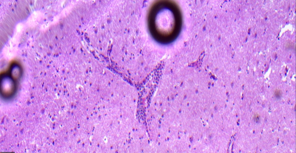 TuftsMCPathRes's tweet photo. Can you guess the organ? 
Can you guess the disease? This is a frozen from a case we had this week with @MonikaPilichow1 #MedTwitter #PathTwitter #PathMatch2025 https://t.co/ZN3GKNIZvW