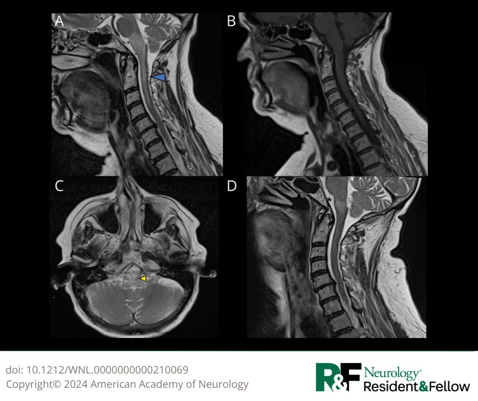 Teaching NeuroImage: Medullary Edema Due to Dural Arteriovenous Fistula—A Potentially Characteristic Imaging Finding bit.ly/3CPNq2j

#NeurologyRF