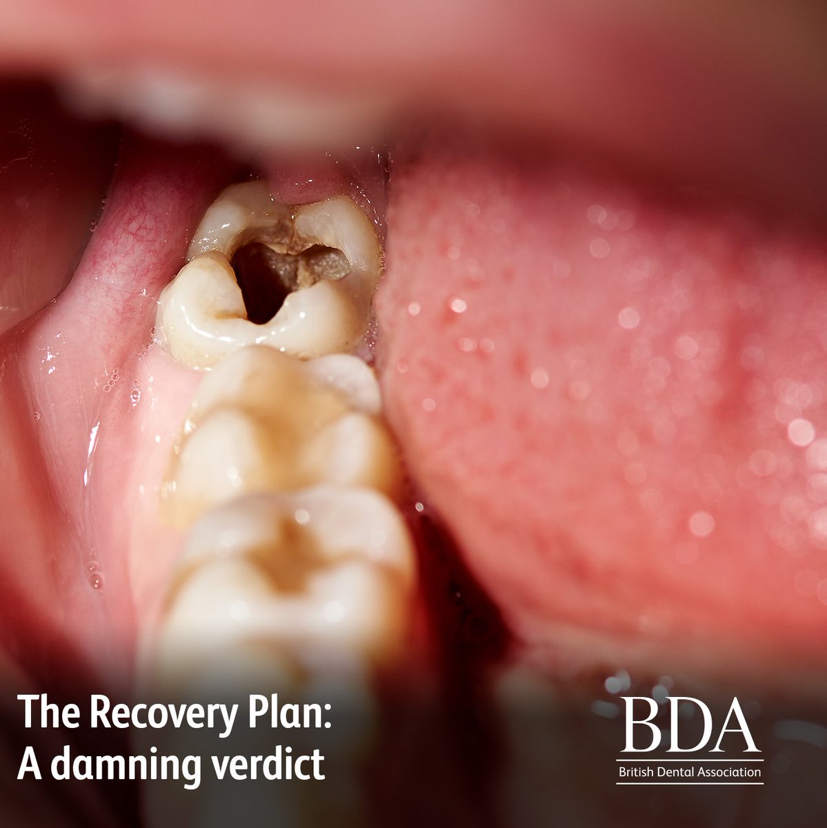 TheBDA's tweet image. The National Audit Office’s report shows the need for fundamental reform in NHS dentistry. 

Learn more: bda.org/news-and-opini…