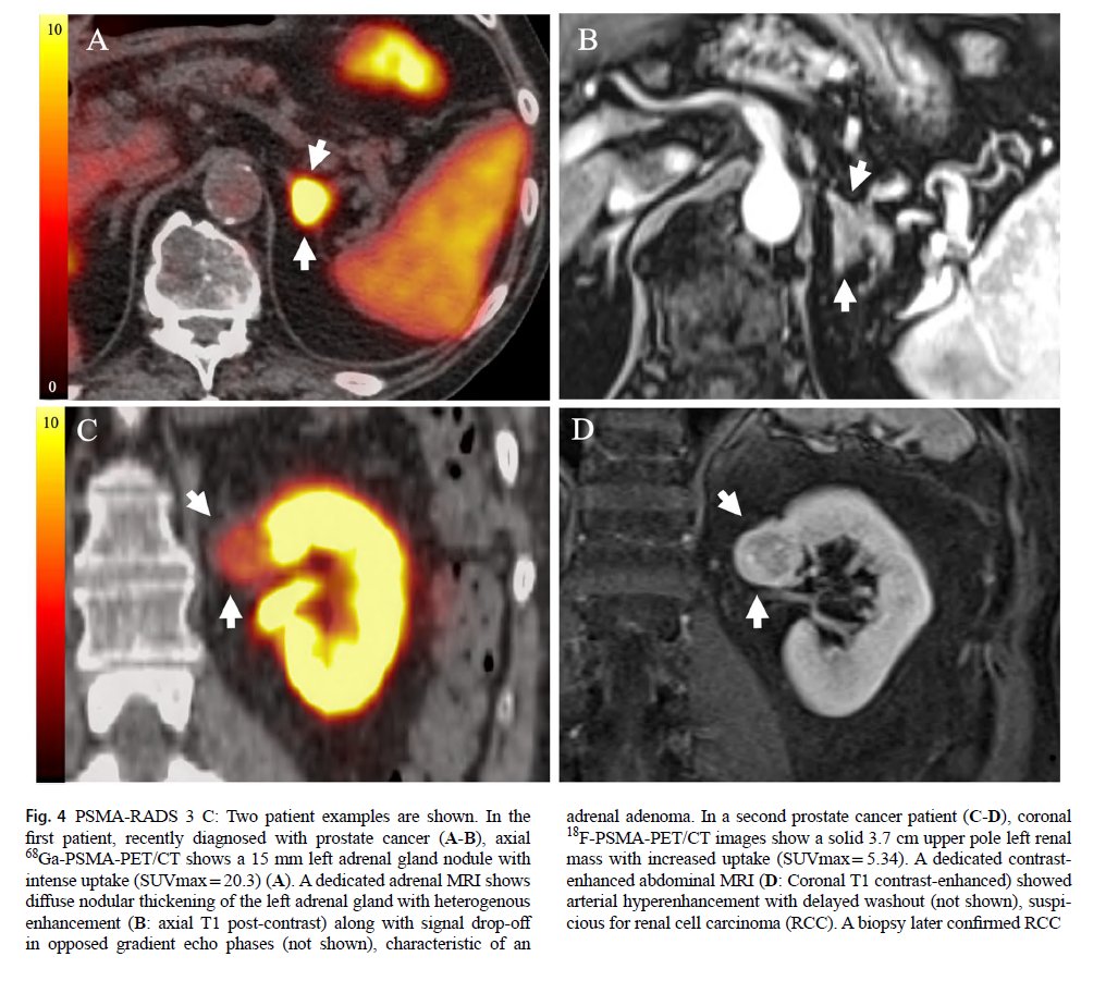 radiolobt's tweet image. &quot;PSMA-RADS to improve evaluation and management of prostate cancer&quot;
link.springer.com/article/10.100…
#MolecularImaging #ProstateCancer #CancerResearch
