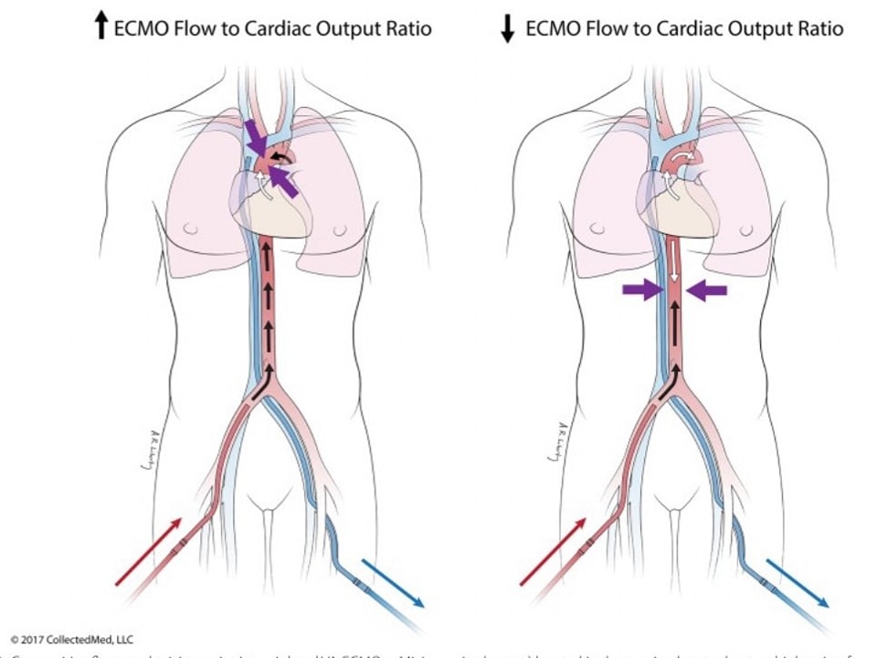 ZHeart11768530's tweet photo. 🔴Position paper on the physiology and nomenclature of dual circulation during venoarterial ECMO in adults⤵️ #2024Review 

🔹https://t.co/9Kiy5myiUL
#ECMO #VA #ECLS #Dualcirculation https://t.co/pFKdUlV61e