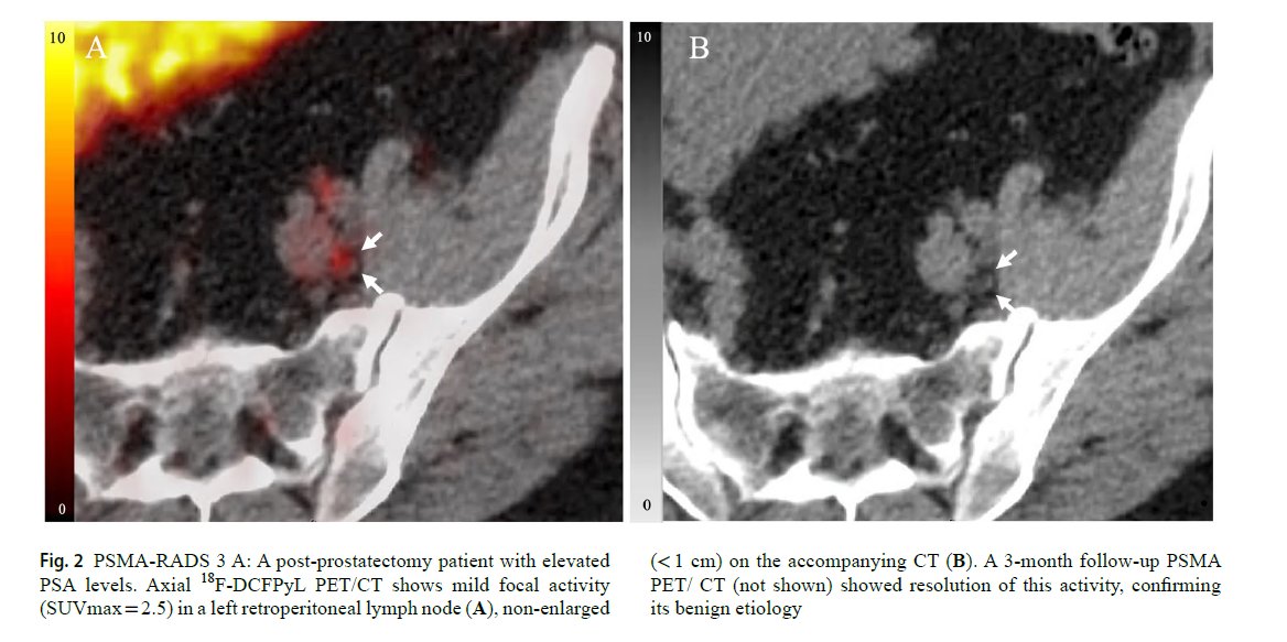 radiolobt's tweet image. &quot;PSMA-RADS to improve evaluation and management of prostate cancer&quot;
link.springer.com/article/10.100…
#MolecularImaging #ProstateCancer #CancerResearch