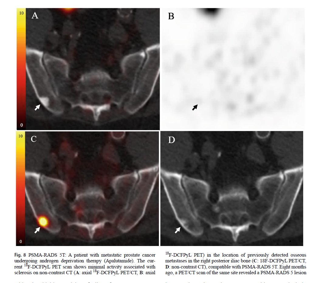 radiolobt's tweet image. &quot;PSMA-RADS to improve evaluation and management of prostate cancer&quot;
link.springer.com/article/10.100…
#MolecularImaging #ProstateCancer #CancerResearch