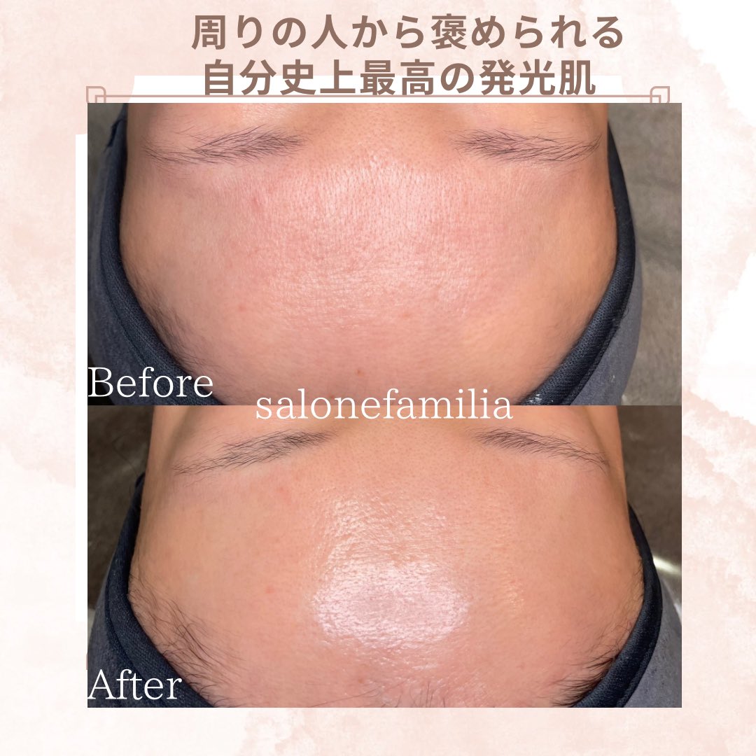 salone_familia_'s tweet photo. 担当させて頂いたお客様が
前回のお手入れ後
「史上最高に綺麗で職場の皆に肌発光してる！って言われたんです！💕肌だけ見せにサロンに行こうかと思いました！💓」

ととっても嬉しいことを言ってくださり

確かにこれだけ艶がでていたら
周りの方からもお肌ほめられますよね🥹🥰💓 https://t.co/O5JcaehFaE