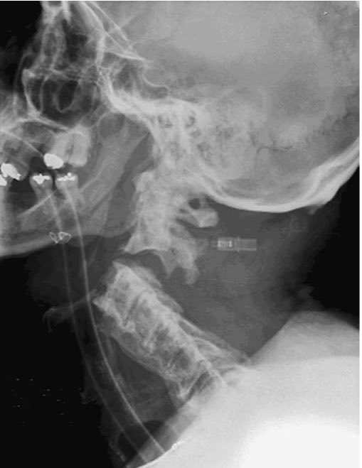OGdukeneurosurg's tweet photo. 57 yo male, MVC, C2-3 complete dislocation who survived with only mild weakness, how? https://t.co/lzOmj1l84J