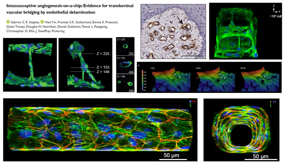 HaoYin20's tweet image. 1st Preprint from Pickering lab @SchulichMedDent!✌️
Led by our talented PhD candidate Sabrina Staples @sabsinthelab
#SciArt

Intussusceptive angiogenesis-on-a-chip: Evidence for transluminal vascular bridging by endothelial delamination

PDMS #Microfluidics channel (80 µm φ)…