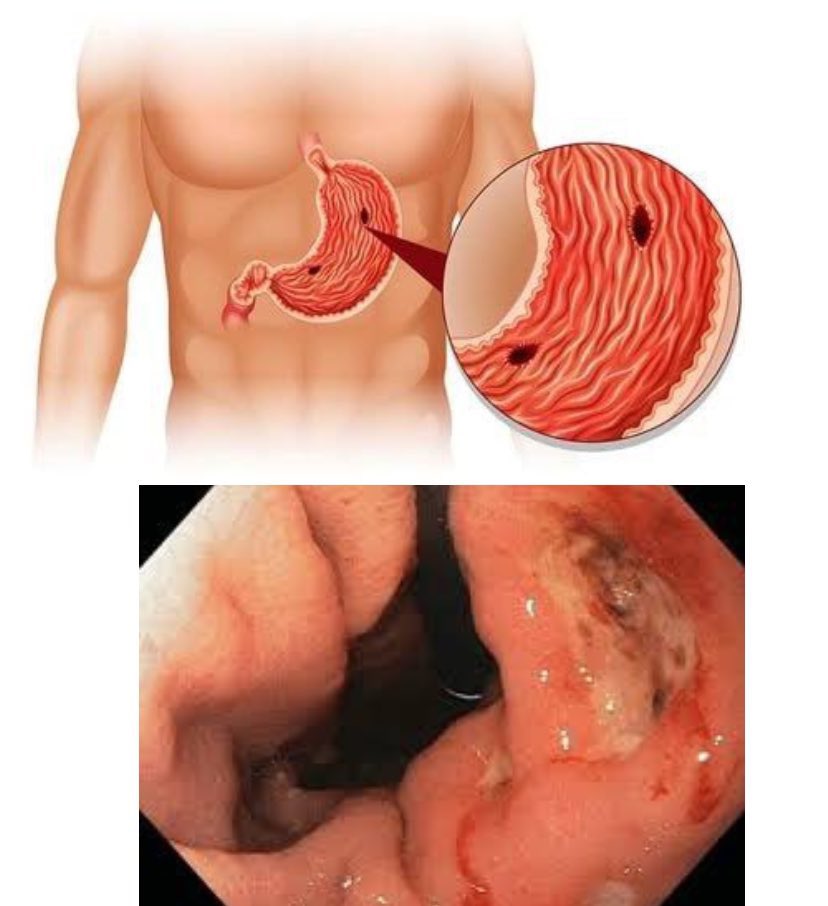 PEPTIC ULCER: WHY IT’S  NOT HEALING FOR SO LONG 

The first step in achieving  a cure for peptic ulcer  is identifying the type 

Is it Stomach Ulcer or Duodenal Ulcer ? 

In this thread, you will learn the difference and some habit that have been making your symptoms worse