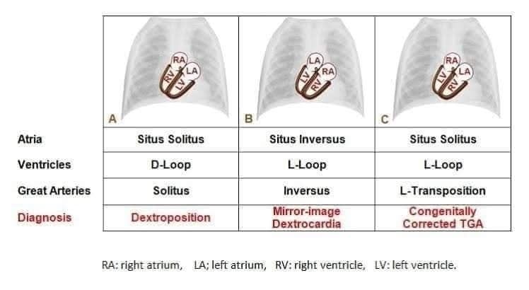ZHeart11768530's tweet photo. 🔴 #ECG Features of #Dextrocardia
#cardiology #diagnosis #differential #ekg #abnormalities #algorithmictrading https://t.co/YRMKunOLNc