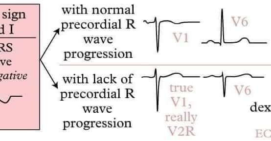 ZHeart11768530's tweet photo. 🔴 #ECG Features of #Dextrocardia
#cardiology #diagnosis #differential #ekg #abnormalities #algorithmictrading https://t.co/YRMKunOLNc