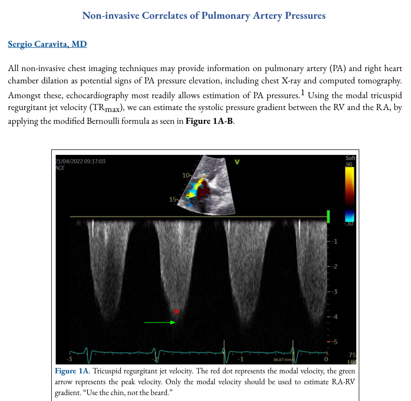 Matt Siuba (@msiuba) on Twitter photo Next chapter of ShockWaves is live!
Non-invasive correlates of pulmonary artery pressures, the second act to <a href="/CaravitaSergio/">Sergio Caravita</a>'s masterful invasive chapter. Next chapter of ShockWaves is live!
Non-invasive correlates of pulmonary artery pressures, the second act to <a href="/CaravitaSergio/">Sergio Caravita</a>'s masterful invasive chapter.