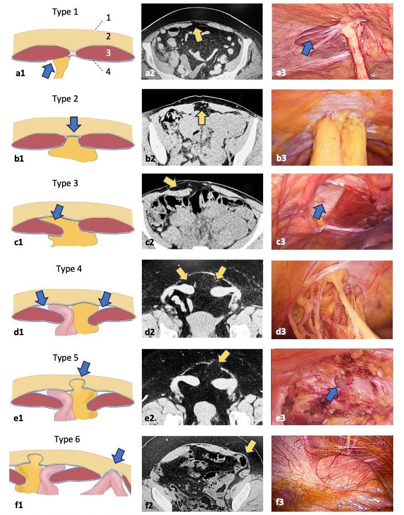 Artur Zanellato (@arturzanellato) on Twitter photo The current classification of c-sections hernia. Grateful to <a href="/ericpaulimd/">Eric Pauli</a> for suggestion and <a href="/FilipMuysoms/">Filip Muysoms</a> and MiguelUreña for providing image, which illustrates type 6. It is the result of lateral advancement, which cuts the int. oblique above the conjoint tendon or through it The current classification of c-sections hernia. Grateful to <a href="/ericpaulimd/">Eric Pauli</a> for suggestion and <a href="/FilipMuysoms/">Filip Muysoms</a> and MiguelUreña for providing image, which illustrates type 6. It is the result of lateral advancement, which cuts the int. oblique above the conjoint tendon or through it