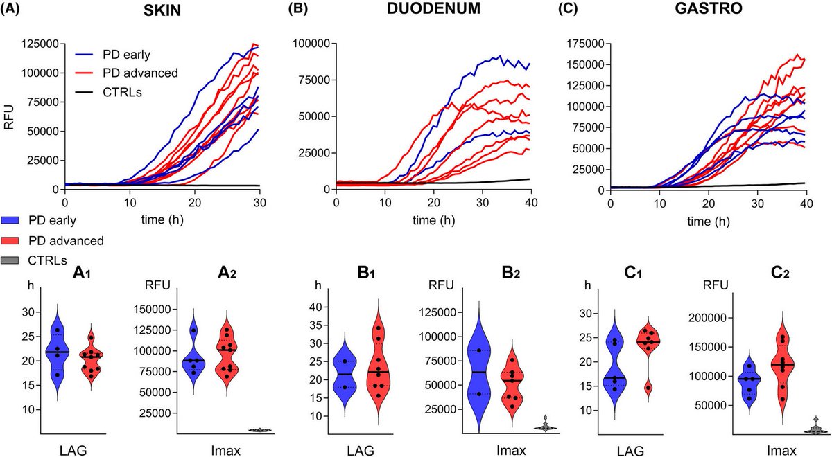 ScienceofPD's tweet photo. Researchers assessed RT-QuIC seeding amplification assay in gut &amp; skin biopsies from early &amp; advanced-stage #Parkinsons; Detection sensitivity was higher in advanced PD, may reflect diff.s in burden &amp; distribution of α-syn within peripheral tissues
https://t.co/XT37QuUCIH https://t.co/KgDV78PbDp