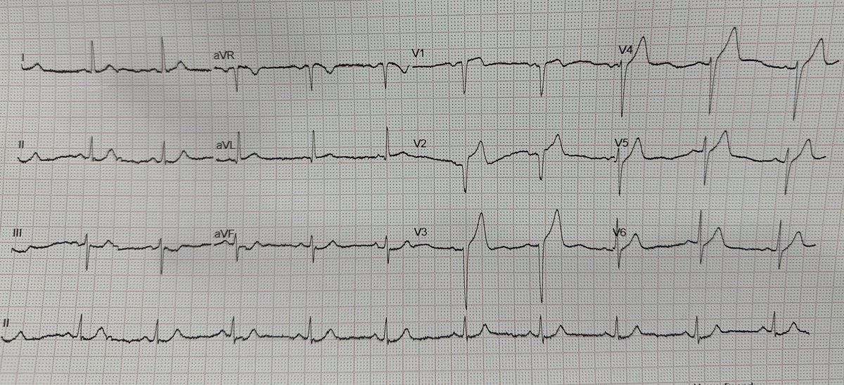 Chest pain

Dx ?