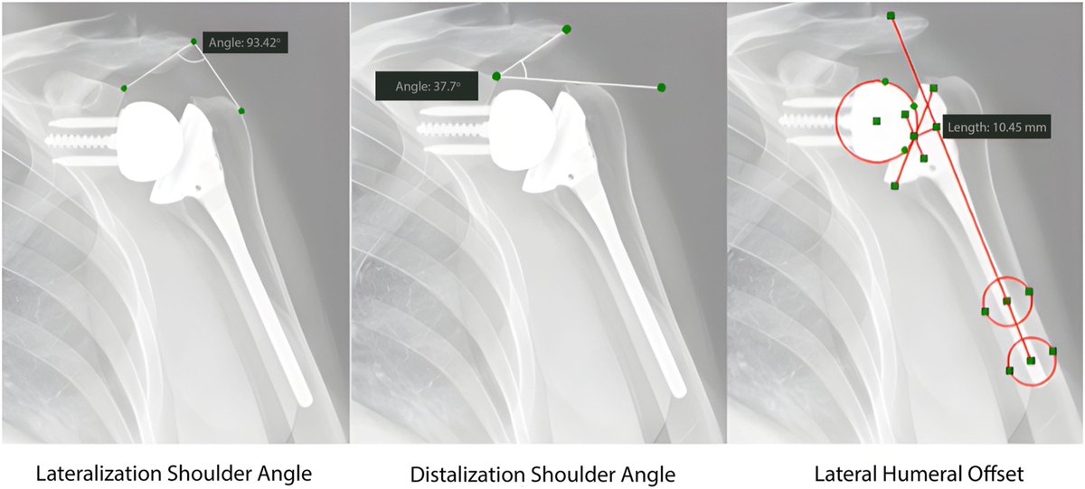 Implant-Positioning and Patient Factors Associated with Acromial and Scapular Spine Fractures After Reverse Shoulder Arthroplasty

#shoulderelbow

bit.ly/4ems6Qi