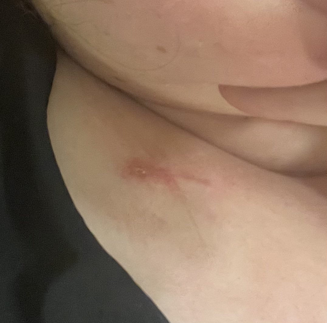 taracdennehy's tweet image. Does anyone else with a port ever feel a pressure/pulling feeling in their neck along the path where the catheter is threaded?

#NEISvoid #DisabilityTwitter #RareDisease