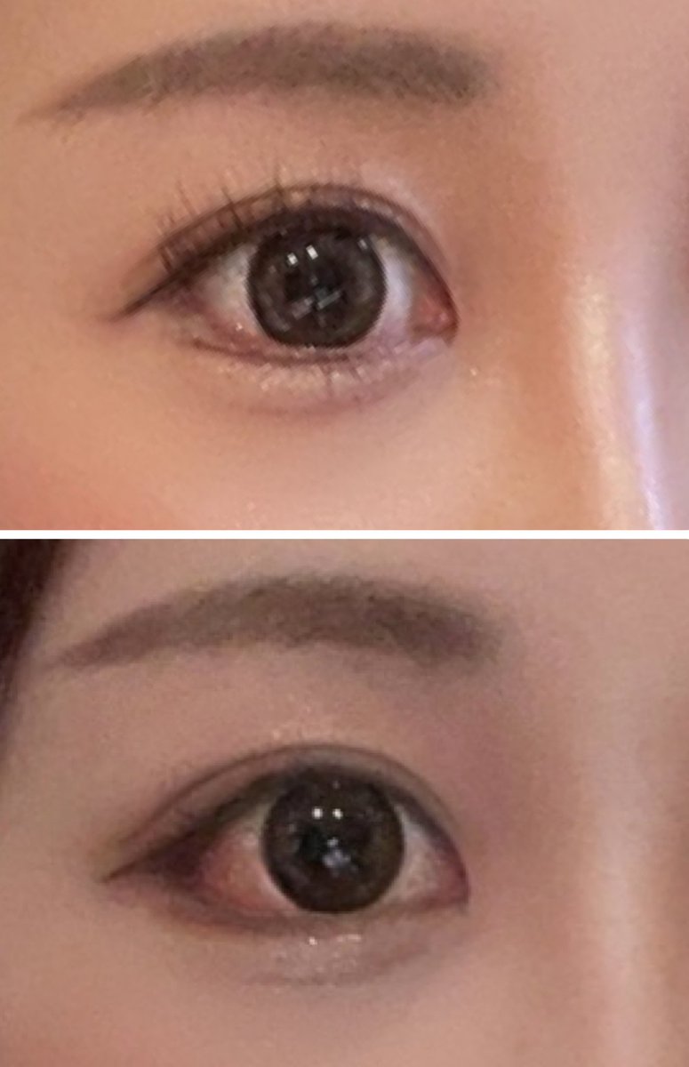 韓国で目尻デュアル切開した時の
今でも後戻りなく満足🫶