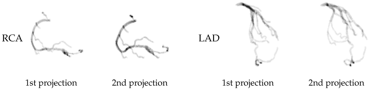 Bioeng_MDPI's tweet photo. 🔬 Excited to share the new publication "NeCA: 3D Coronary Artery Tree Reconstruction from Two 2D Projections via Neural Implicit Representation" @abhirupb88  👉 https://t.co/t0tjyFl4Ka

#3D #coronary_artery #reconstruction #self_supervised_learning #deep_learning https://t.co/RWPbASPHri