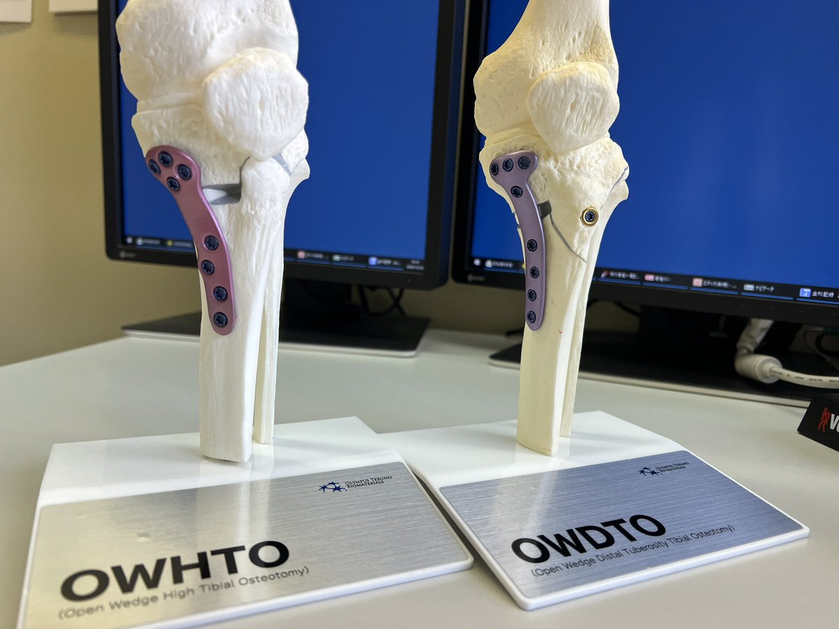 hiroshi0273's tweet image. Tris Preserve RoseプレートとTris Purple プレート🦵　　　

#日本膝関節学会
#sigmax 
#オリンパス 
#arthrex 
#trispreserverose 
#olympus
#medicad 
#東陽テクニカ
#mios 
#膝周囲骨切り術
#arhtroscopicbeltcapsulodesis
#内側半月板逸脱
#半月板縫合
#ABC法