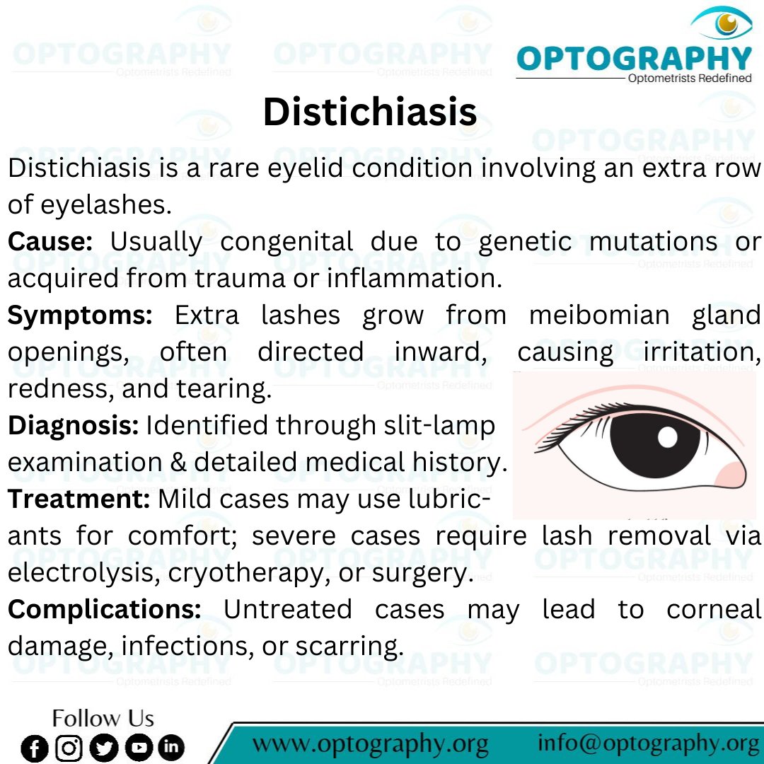 Optography8's tweet photo. Distichiasis: When an extra row of lashes causes discomfort and eye irritation. Early diagnosis and treatment can protect your vision. #Distichiasis #Optography #RareEyeCondition #EyelidHealth #VisionCare #Thatoptometrist #Optometry https://t.co/0TEhqJcEYV