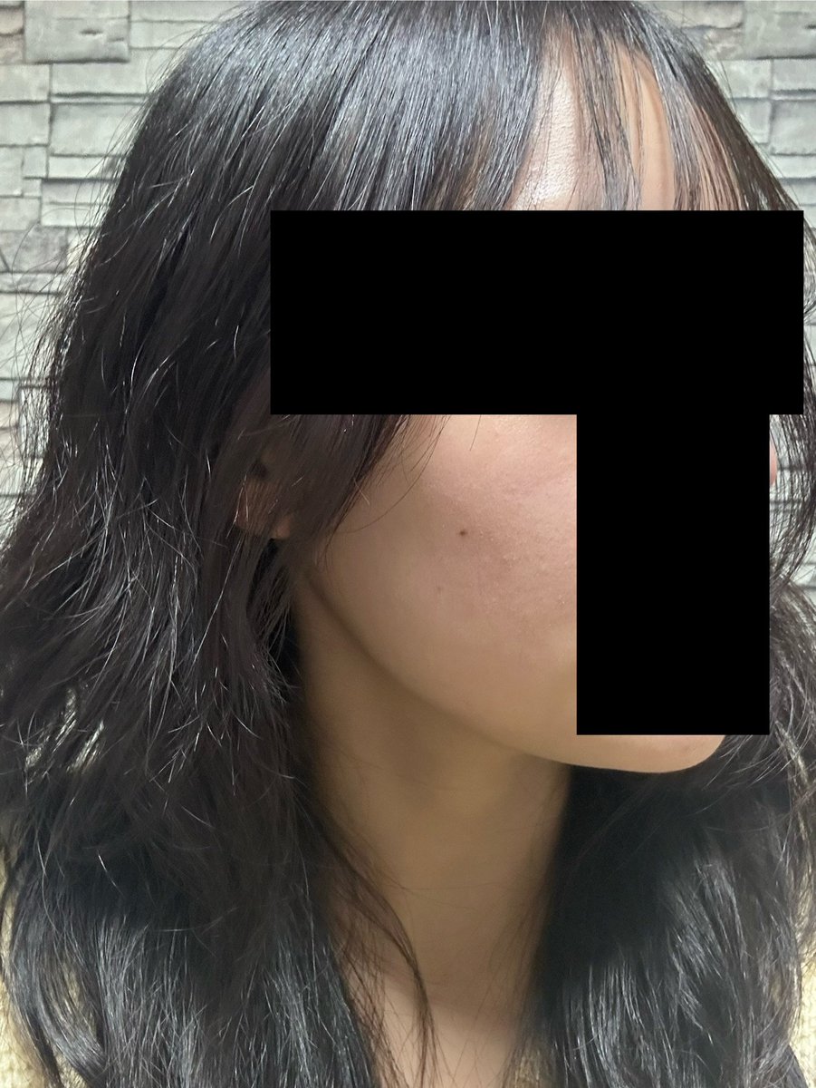 手術名 -エラ削り
麻酔方法 - 睡眠麻酔
術後三か月目

あごの筋肉が発達した方には、あごの筋肉切除術を一緒におすすめします。

#自撮り #セルフィー#芸能人 #自己管理
#インフルエンサー #形成外科 #皮膚科 #輪郭成形 
#輪郭手術 #エラ削り #あごの手術 #整形前後
#整形手術 #輪郭3種 #頬骨縮小