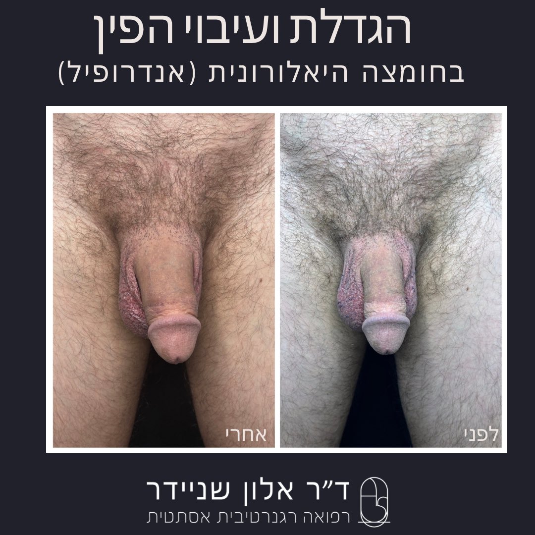 שדרגו את הביטחון העצמי שלכם עם שיטת AndroFill להגדלת הפין באמצעות חומצה היאלורונית! הטיפול המתקדם, הבטוח והיעיל, מאפשר להגדיל את נפח ואורך הפין בצורה טבעית ומותאמת אישית, ללא צורך בניתוח או זמן החלמה ממושך. עם שימוש בחומצה היאלורונית איכותית, התוצאות נראות לעין מיד לאחר הטיפול,
