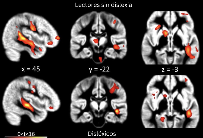 La dislexia no es un déficit cerebral.

Es un superpoder que el sistema educativo no entiende.

No necesitas 'corregirla’, sino desbloquear su potencial. Cuando lo hagas pensarás en dimensiones que el 99% no puede acceder.

Aquí está cómo convertir tu dislexia en tu superpoder: