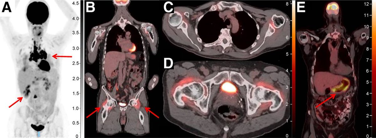JournalofNucMed's tweet image. JNM Continuing Education: Precision oncology in #melanoma. ow.ly/STV650Us0Sj 

#NuclearMedicine #MolecularImaging #RPTherapy