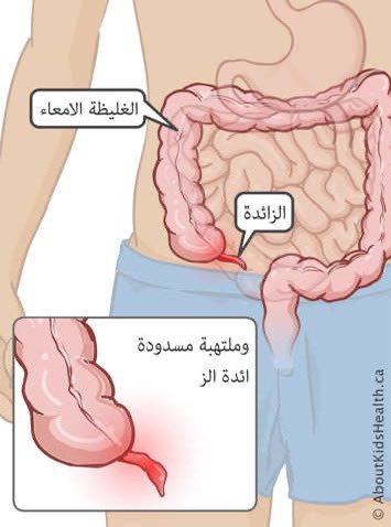 Shalianho's tweet photo. التهاب الزائدة الدودية: الأسباب، الأعراض، والعلاج

التهاب الزائدة الدودية هو حالة طبية طارئة تحدث نتيجة التهاب الزائدة الدودية، وهي جزء صغير على شكل أنبوب يقع في الجانب الأيمن السفلي من البطن، ومتصل بالأمعاء الغليظة. على الرغم من أن وظيفتها الدقيقة غير معروفة، فإن التهابها قد يؤدي إلى مضاعفات خطيرة إذا لم يتم علاجه بسرعة.

أسباب التهاب الزائدة الدودية

التهاب الزائدة الدودية يحدث عادةً بسبب انسدادها نتيجة:
1.تراكم الفضلات أو البراز المتصلب في تجويفها.
2.عدوى ناتجة عن بكتيريا أو فيروس يؤدي إلى تورم الزائدة.
3.أمراض التهابية معوية مثل مرض كرون.
4.أسباب أخرى نادرة كوجود جسم غريب أو طفيليات داخل الزائدة.

أعراض التهاب الزائدة الدودية

الأعراض تظهر عادة فجأة وتزداد حدة مع مرور الوقت. وتشمل:
1.ألم في الجانب الأيمن السفلي من البطن: يبدأ الألم غالبًا حول السرة وينتقل تدريجيًا إلى الجزء السفلي الأيمن.
2.فقدان الشهية: يعتبر عرضًا شائعًا.
3.الغثيان والقيء: يظهران عادة بعد بدء الألم.
4.ارتفاع طفيف في درجة الحرارة: قد ترتفع درجة الحرارة لتصل إلى 38 درجة مئوية أو أعلى.
5.انتفاخ البطن وصعوبة في تمرير الغازات.
6.أعراض أخرى مثل الإمساك أو الإسهال.

مضاعفات التهاب الزائدة الدودية

إذا تُرك دون علاج، قد يؤدي التهاب الزائدة إلى:
1.تمزق الزائدة الدودية: مما يسبب انتشار العدوى في البطن (التهاب الصفاق).
2.خُراج: تجمع للقيح في منطقة البطن.
3.عدوى جهازية خطيرة: قد تصل إلى الدم (الإنتان).

تشخيص التهاب الزائدة الدودية

يتم التشخيص بناءً على:
1.الفحص السريري: بالضغط على البطن لتحديد موضع الألم.
2.اختبارات الدم: للكشف عن ارتفاع خلايا الدم البيضاء التي تشير إلى وجود التهاب.
3.التصوير الطبي: مثل التصوير بالموجات فوق الصوتية أو الأشعة المقطعية لتأكيد التشخيص.

علاج التهاب الزائدة الدودية

العلاج الأساسي هو استئصال الزائدة الدودية، والذي يتم عادةً بإحدى الطرق التالية:
1.الجراحة المفتوحة: يتم فيها إزالة الزائدة عبر شق جراحي في البطن.
2.الجراحة بالمنظار: تقنية أقل توغلاً تستخدم كاميرا وأدوات صغيرة.

في بعض الحالات المبكرة، قد يُوصى باستخدام المضادات الحيوية لتخفيف الالتهاب، ولكن الجراحة تبقى الحل النهائي.