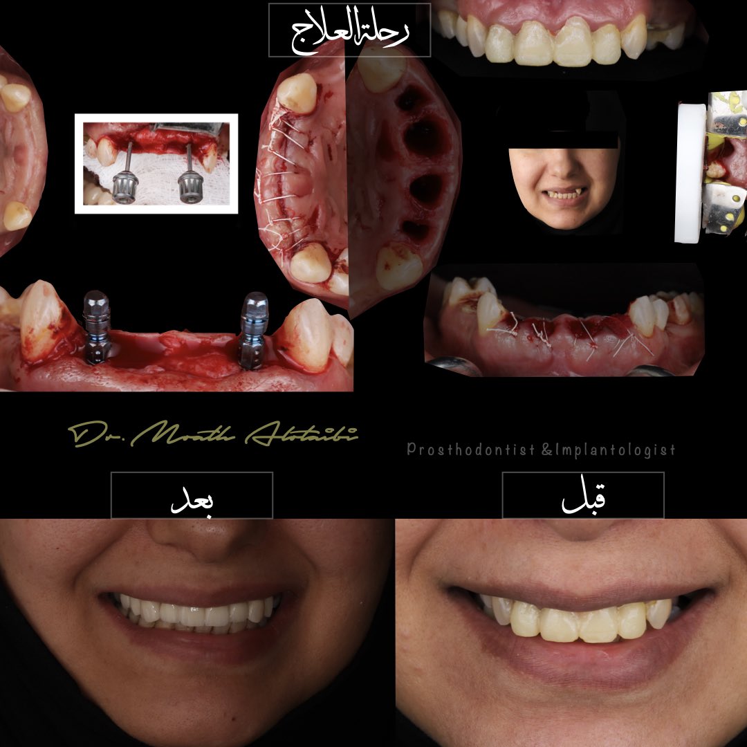 ردينا ابتسامتها بشكل افضل وعالجنا البروز😍

استخدمت فيها احدث الطرق للمحافظة على العظم المحيط بالاسنان
وترميمها بالسبل المثالية والمثبته علميا.

الجراحة وزراعة العظم و الاسنان معاي
والتركيبات مع د.نواف القاضي
<a href="/nawafk77/">نـواف الـقـاضـي</a> ❤️