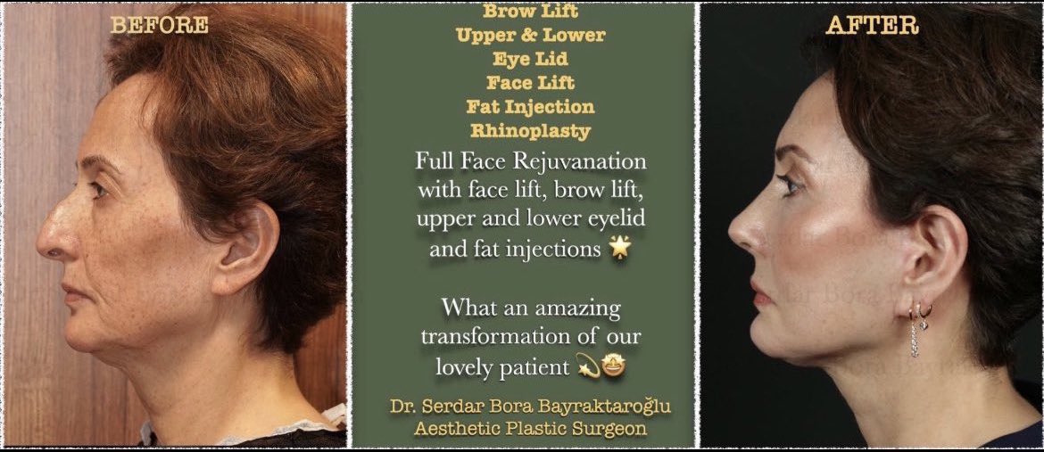 Clinicsbbintl's tweet photo. BROW LIFT/ UPPER & LOWER EYE LID/ FACE LIFT/ FAT INJECTION/RHINOPLASTY
You can get rid of the tired appearance of aging with all facial rejuvenation.
#beforeafter #browlift #uppereyelidsurgery #lowereyelidsurgery #facelift #fatinjection #fullfacerejuvenation #brow #face #rhino https://t.co/Fc1PPlxbhK