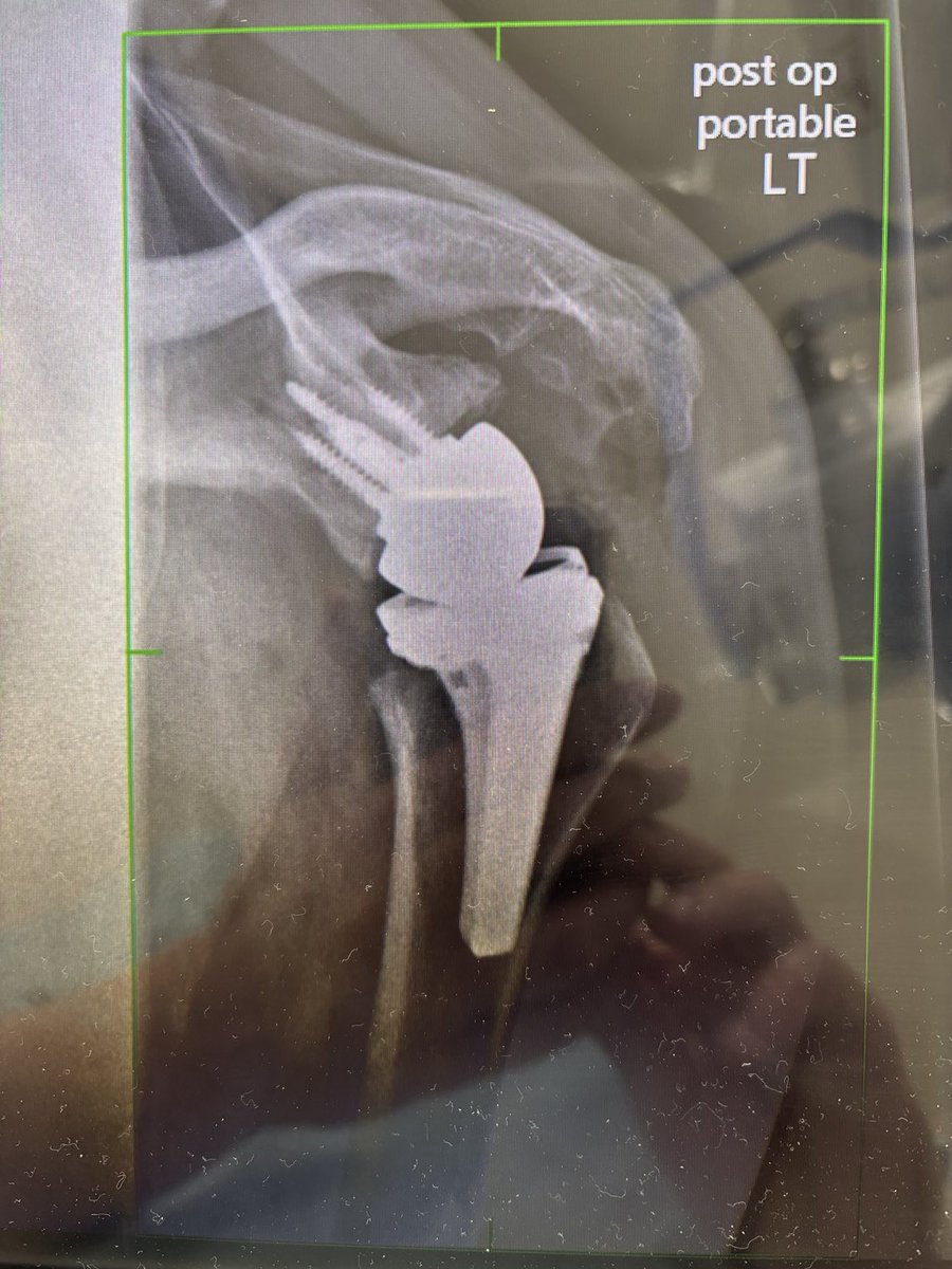 DrRobertKlapper's tweet photo. KLAPPERVISION. My favorite Surgery for Arthritis of the Shoulder! The ReverseShoulder! Make the Ball into the Socket and the Socket into the Ball! #GeniusIdea https://t.co/6njOqxZ4WT