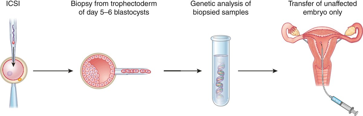 Kidney International (@kidney_int) on Twitter photo Prenatal and preimplantation genetic testing for monogenic kidney disorders
doi.org/10.1016/j.kint…
#OpenAccess #KIMiniReview #genetickidneydisease #kidney #geneticcounseling <a href="/univgroningen/">University of Groningen</a> <a href="/UMCGgenetica/">UMCG Genetica</a> Prenatal and preimplantation genetic testing for monogenic kidney disorders
doi.org/10.1016/j.kint…
#OpenAccess #KIMiniReview #genetickidneydisease #kidney #geneticcounseling <a href="/univgroningen/">University of Groningen</a> <a href="/UMCGgenetica/">UMCG Genetica</a>