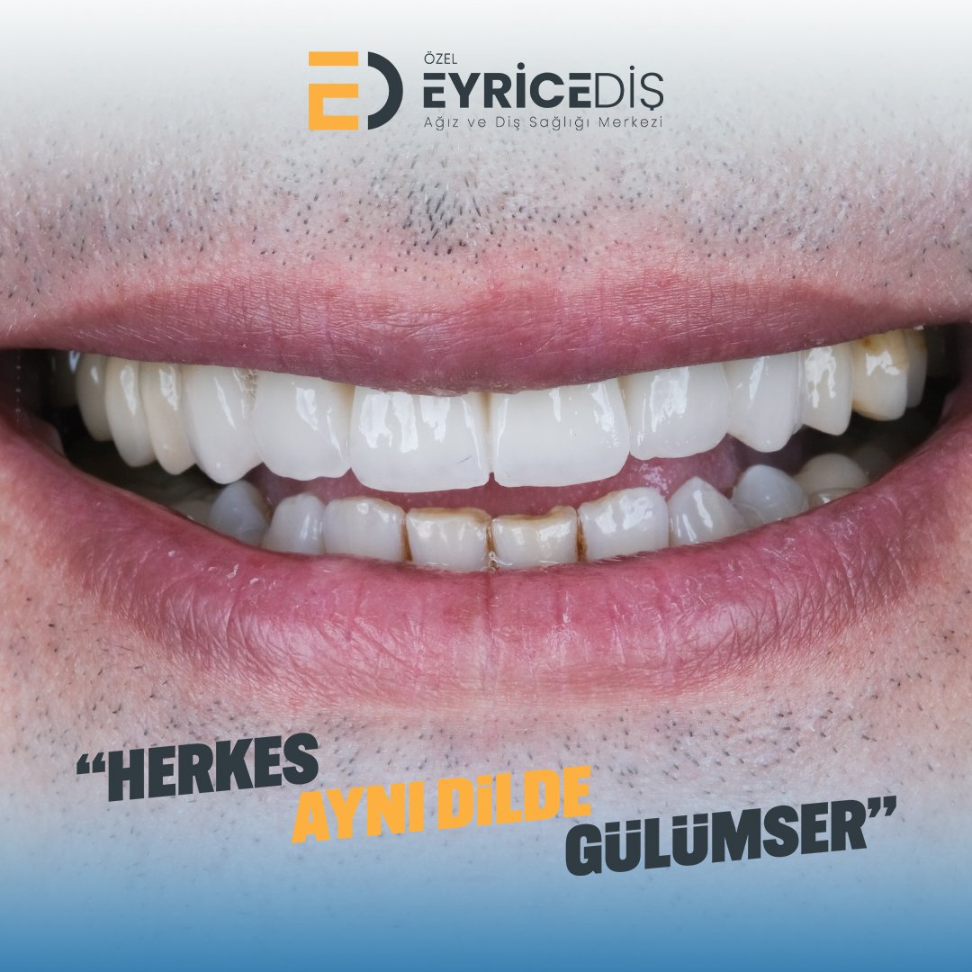 Daha Detaylı Bilgi Ve Randevu İçin;

📞 444 1 496
✉️ info@eyricedis.com.tr
🌐 eyricedis.com.tr
📍 Esentepe Mah. Kasap Sok. No:1 FSM Bul. Nilüfer/Bursa

#eyricediş #herkesaynıdildegülümser