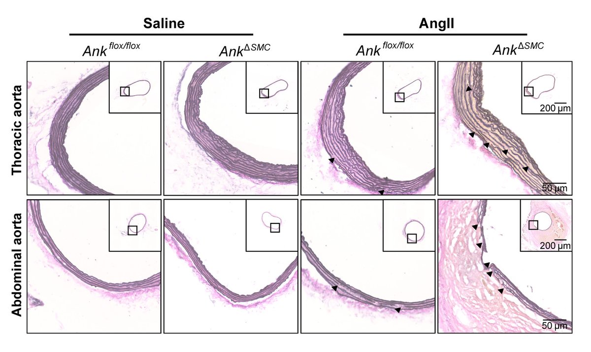 CircRes's tweet image. Wu et al discovered that cytosolic #citrate accumulation resulted from #ANK deficiency &amp;amp; drives proinflammatory fate of #SMCs to promote aortic #aneurysm development. Find out more at ahajrnls.org/4fxzisp

@PKU1898