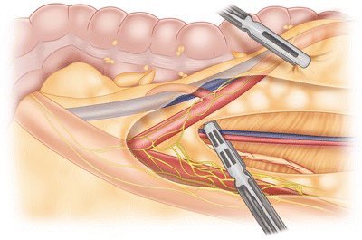 PipeCabreraV's tweet photo. Surgical pearl: during right colectomy always be careful with the duodenum ✋‼️and during left colectomy always be careful with the left ureter ⤵️💡@pferrada1 @juliomayol @SWexner @TomVargheseJr @DrThawaba @LiangRhea @sminaev2015 https://t.co/lrvuNHLtIh