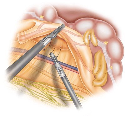 PipeCabreraV's tweet photo. Surgical pearl: during right colectomy always be careful with the duodenum ✋‼️and during left colectomy always be careful with the left ureter ⤵️💡@pferrada1 @juliomayol @SWexner @TomVargheseJr @DrThawaba @LiangRhea @sminaev2015 https://t.co/lrvuNHLtIh