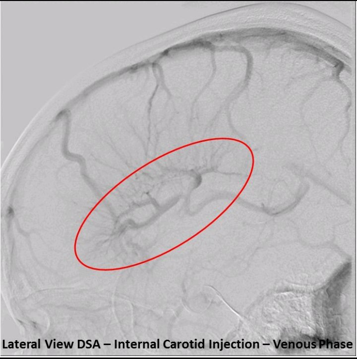 Pouria Moshayedi, MD PhD (@pouriamoshayedi) on Twitter photo Interesting findings on anatomy of deep cerebral veins: Absence of basal vein and dominant internal cerebral vein.
Multiple DVAs? Dominant thalamostriate veins? or both?
<a href="/WFNS_YNF/">WFNS Young Neurosurgeons Forum</a> <a href="/YoungNIR/">YoungNIR</a> <a href="/youngneuros/">AANS Early-to-mid Career Committee (#E2M)</a> <a href="/cvsection/">CV Section</a> <a href="/AsianCNS/">ACNS (Asian Congress of Neurological Surgeons)</a> <a href="/TheASNR/">The American Society of Neuroradiology</a> <a href="/theneuroradguy/">The Neuroradiologist</a> <a href="/INR_WFITN/">Interventional Neuroradiology</a> <a href="/SNISinfo/">SNIS Info</a> Interesting findings on anatomy of deep cerebral veins: Absence of basal vein and dominant internal cerebral vein.
Multiple DVAs? Dominant thalamostriate veins? or both?
<a href="/WFNS_YNF/">WFNS Young Neurosurgeons Forum</a> <a href="/YoungNIR/">YoungNIR</a> <a href="/youngneuros/">AANS Early-to-mid Career Committee (#E2M)</a> <a href="/cvsection/">CV Section</a> <a href="/AsianCNS/">ACNS (Asian Congress of Neurological Surgeons)</a> <a href="/TheASNR/">The American Society of Neuroradiology</a> <a href="/theneuroradguy/">The Neuroradiologist</a> <a href="/INR_WFITN/">Interventional Neuroradiology</a> <a href="/SNISinfo/">SNIS Info</a>