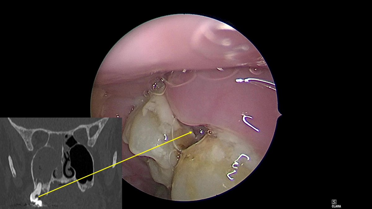 JohnCraigNose's tweet photo. Great case last week worth multiple posts! First, it highlights some cool points from Ch. 2 of the #ODS #OCNA @PlasSurgENTClin issue on #endodontic and #perio dental anatomy. Root anatomy is MUCH more complex than most doctors know! For one, can have multiple apical foramina per root. This case also shows an "endo-perio" lesion. Much more to learn in Ch. 2! Oh, and yes, I PULLED THIS TOOTH!!! 😂😎🦷🥸 @ent_ams @MartaKwiat_ska @NoenkoI @Auditor_is_here