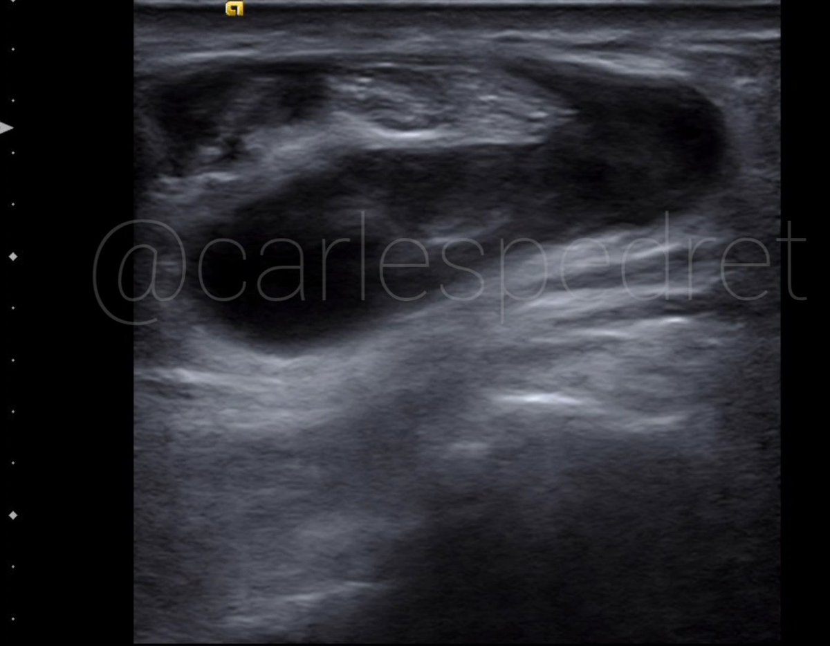 Day 23 (a few hours late) of the #AdventCalendarOfUltrasoundPics 
Transversal #ultrasound scan over the dorsal foot. Severe tibialis anterior tenosynovitis.