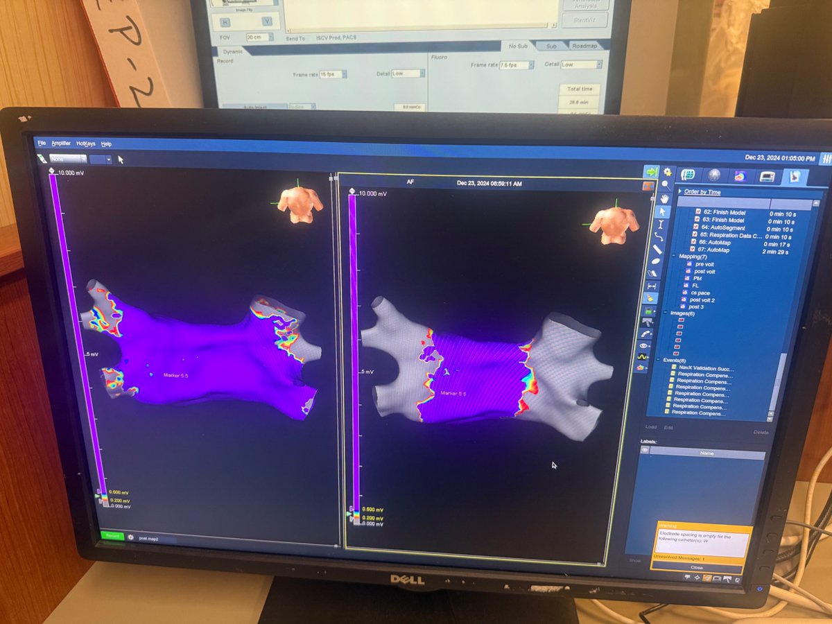First PVI with FARAPULSE PFA … exciting time to be in EP