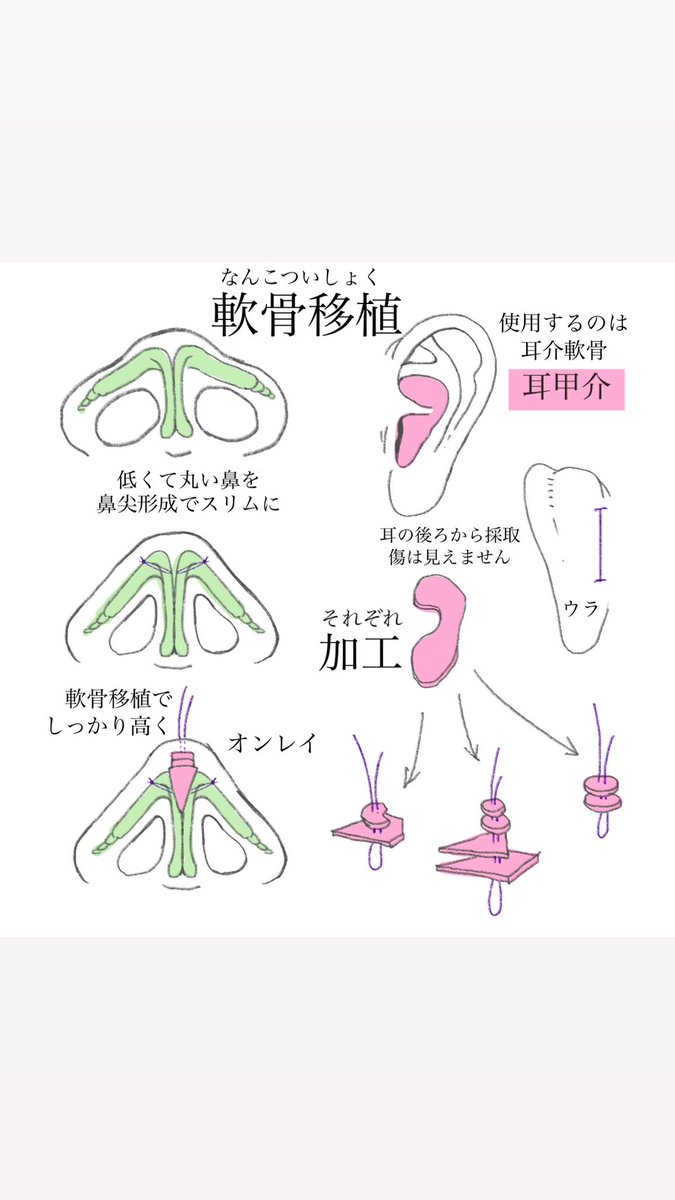camy_illust's tweet photo. わかりやすい鼻整形のイラスト
(無断転載禁止) https://t.co/aqZYdFSZ5S