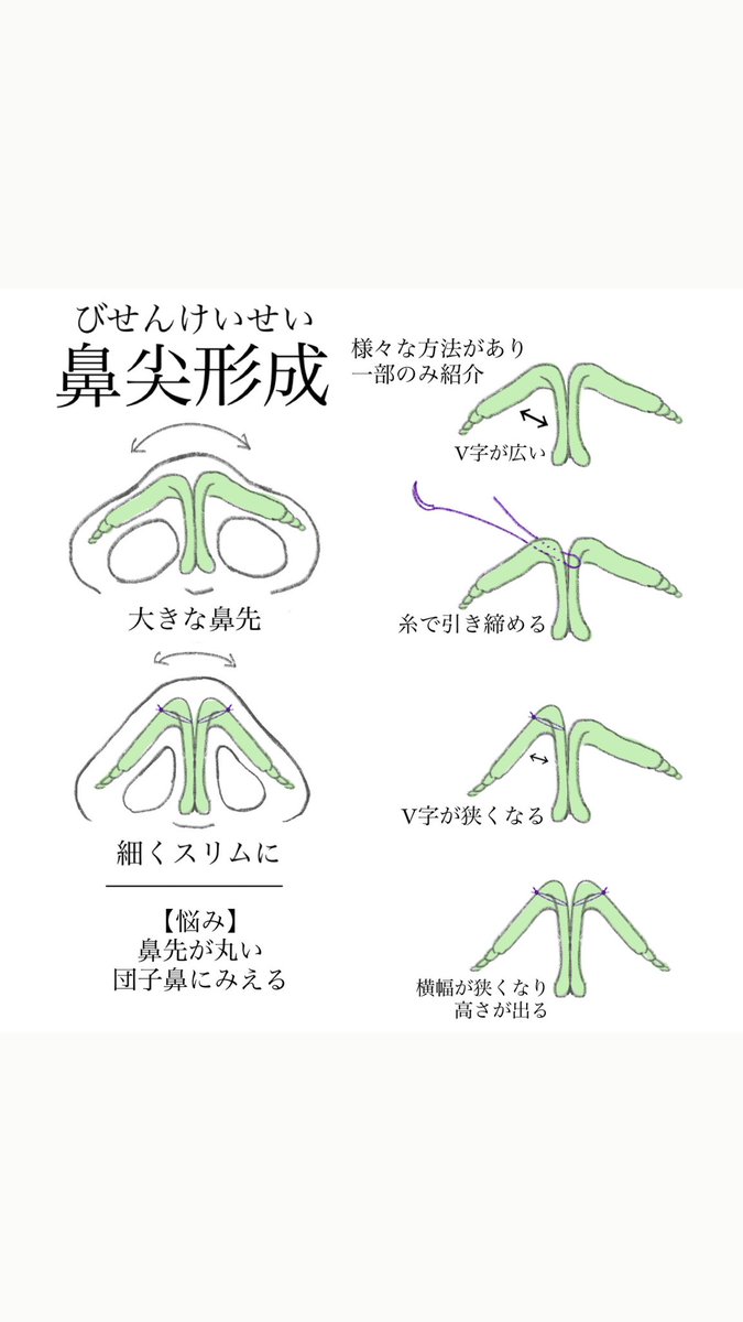 camy_illust's tweet photo. わかりやすい鼻整形のイラスト
(無断転載禁止) https://t.co/aqZYdFSZ5S