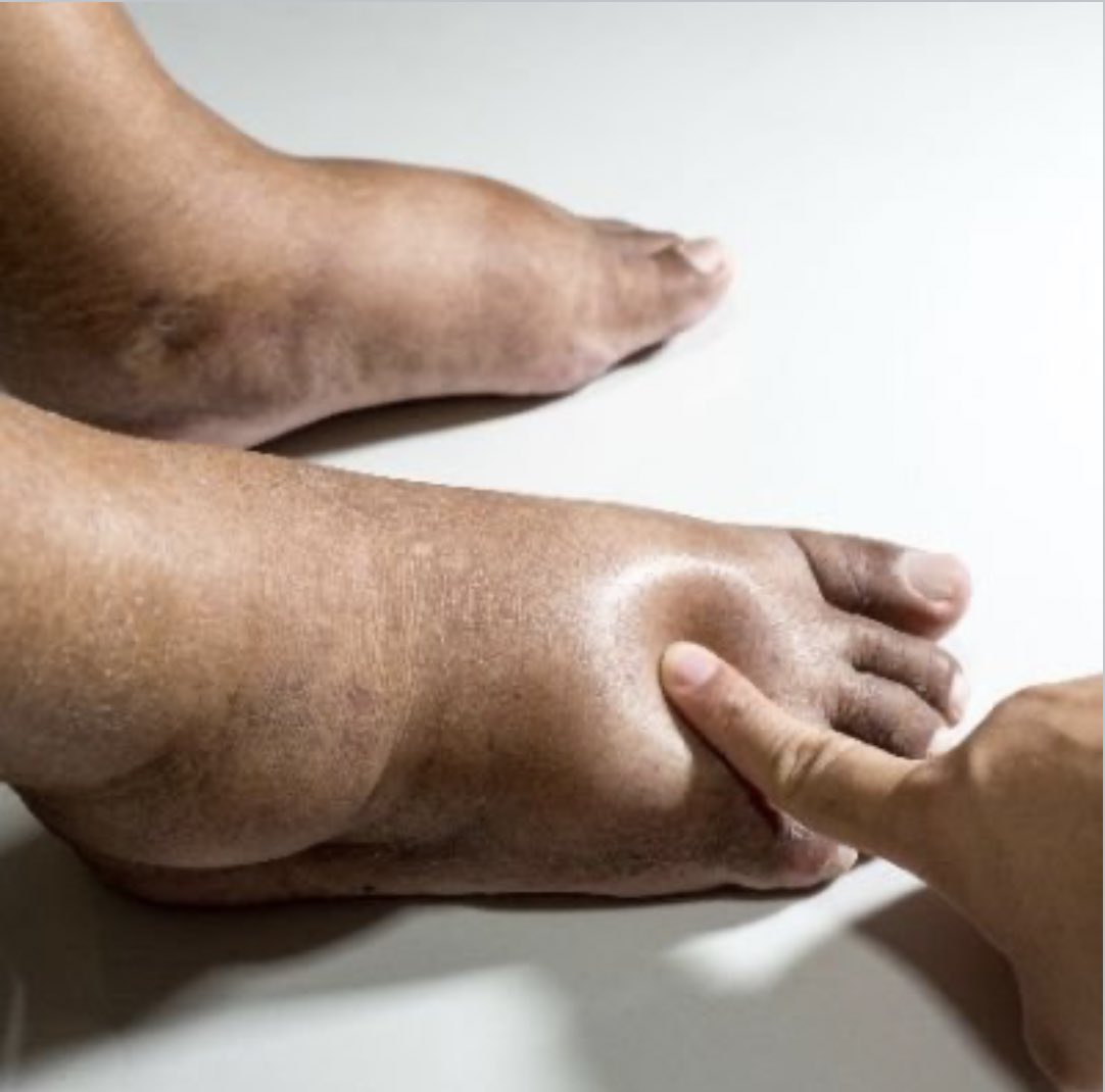 PERIPHERAL EDEMA: SWELLING OF THE EXTREMITIES

Have you ever noticed unexplained swelling in your legs, feet, or hands?

It might be peripheral edema—a condition caused by fluid buildup in the tissues.

What triggers this?
Is it harmless? or does it point to an underlying issue?