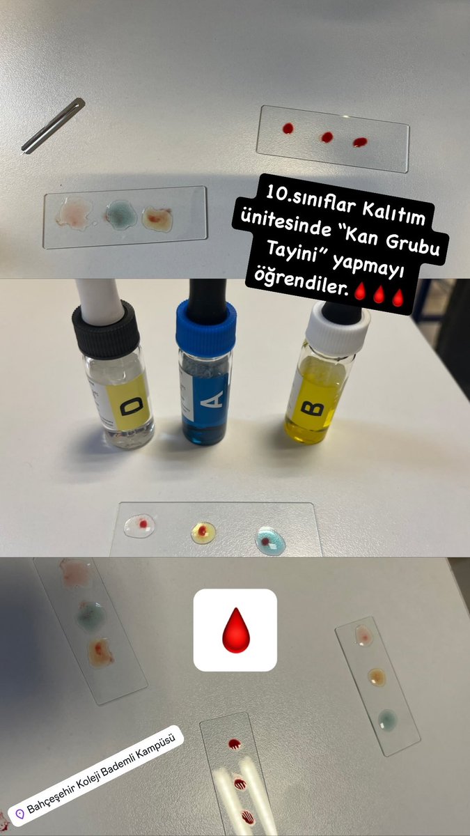 Eda Başaran BK (@edabiyo) on Twitter photo 10.sınıflarla “Kan Grubu Tayini” yaptık, kan grubumuzu öğrendik.🩸🩸🩸🔬🔬🔬#kan #serum #tayin #bkbursabademli <a href="/demirkemal08/">kemal demir</a> <a href="/mehvespamukcuu/">MEHVEŞ PAMUKÇU</a> <a href="/mustafakaskaval/">Mustafa Kaşkaval</a> <a href="/TumaySen/">Tümay Şen</a> <a href="/SenemGkta3/">Senem Göktaş</a> 10.sınıflarla “Kan Grubu Tayini” yaptık, kan grubumuzu öğrendik.🩸🩸🩸🔬🔬🔬#kan #serum #tayin #bkbursabademli <a href="/demirkemal08/">kemal demir</a> <a href="/mehvespamukcuu/">MEHVEŞ PAMUKÇU</a> <a href="/mustafakaskaval/">Mustafa Kaşkaval</a> <a href="/TumaySen/">Tümay Şen</a> <a href="/SenemGkta3/">Senem Göktaş</a>