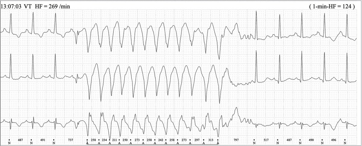 ecgandrhythmRoe's tweet photo. A Holter-strip; is it real? what do you see? https://t.co/UpXk88t3ta