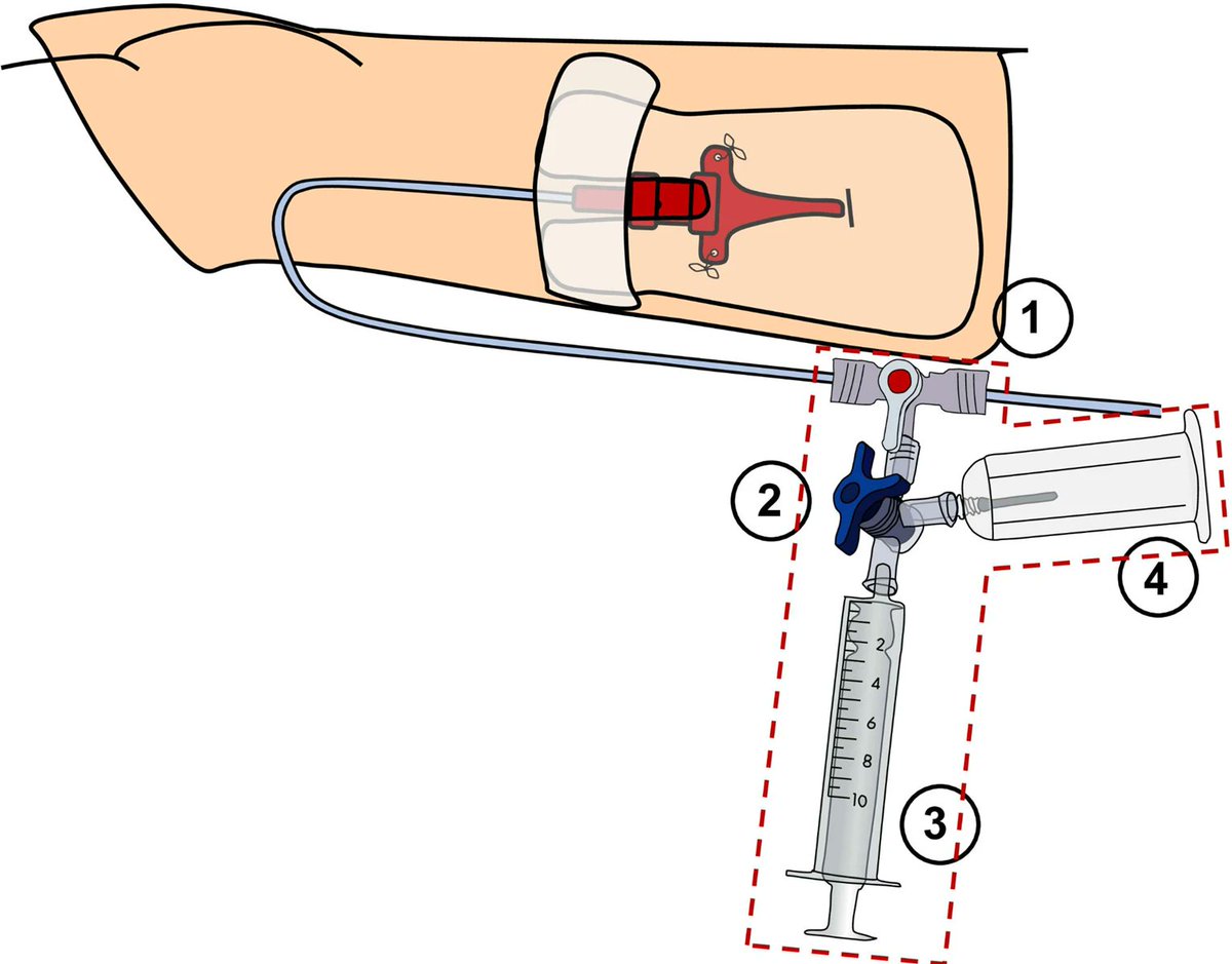 Journal of Clinical Monitoring and Computing (@jcmcsome) on Twitter photo Clot formation risk in the clearing fluid after arterial catheter blood sampling: coagulation factors consumption over time - a prospective pilot study
by <a href="/DauvergneJerome/">jerome dauvergne</a> from <a href="/NantesUniv/">Nantes Université</a> 🇫🇷
link.springer.com/article/10.100… Clot formation risk in the clearing fluid after arterial catheter blood sampling: coagulation factors consumption over time - a prospective pilot study
by <a href="/DauvergneJerome/">jerome dauvergne</a> from <a href="/NantesUniv/">Nantes Université</a> 🇫🇷
link.springer.com/article/10.100…