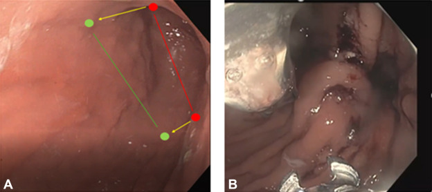 VideoGIE Journal (@videogie) on Twitter photo Alexander J. Podboy et al display "The open accordion: a novel application of endoscopic sleeve gastroplasty for the treatment of refractory gastroparesis" in this Original Article. videogie.org/article/S2468-…
<a href="/AlexanderPodboy/">Alexander Podboy, MD, DABOM</a>
<a href="/KaraRaphael/">Kara Raphael</a> Alexander J. Podboy et al display "The open accordion: a novel application of endoscopic sleeve gastroplasty for the treatment of refractory gastroparesis" in this Original Article. videogie.org/article/S2468-…
<a href="/AlexanderPodboy/">Alexander Podboy, MD, DABOM</a>
<a href="/KaraRaphael/">Kara Raphael</a>