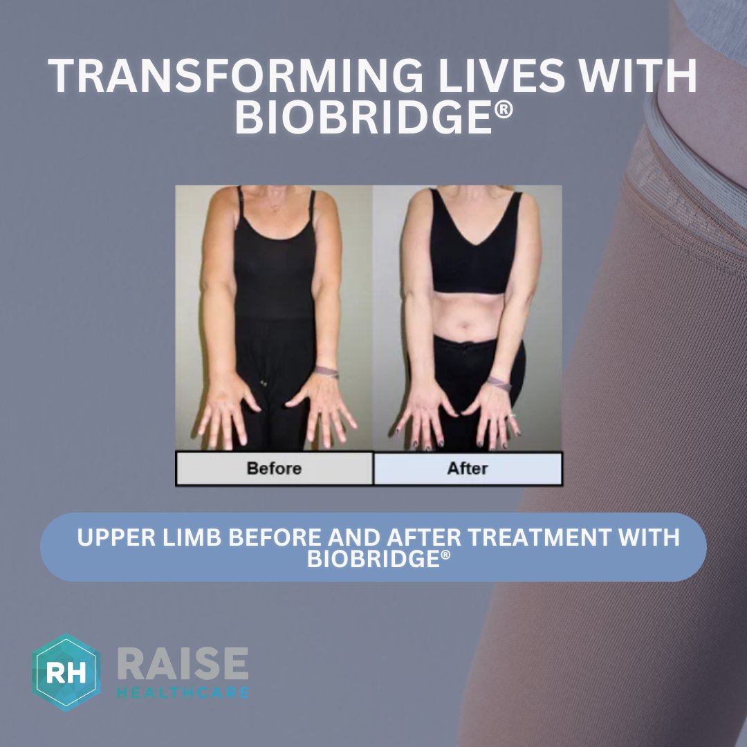 BioBridge® transforms lives and restores lymphatic function with safety and efficacy.

💡Real results from Dr. Dimitris Dionyssiou at The Lymphedema Clinic (Thessaloniki, Greece)

📸 Swipe for before-and-after images!

📞 Learn more: 0121 629 7818 | 🌐 raisehealthcare.co.uk