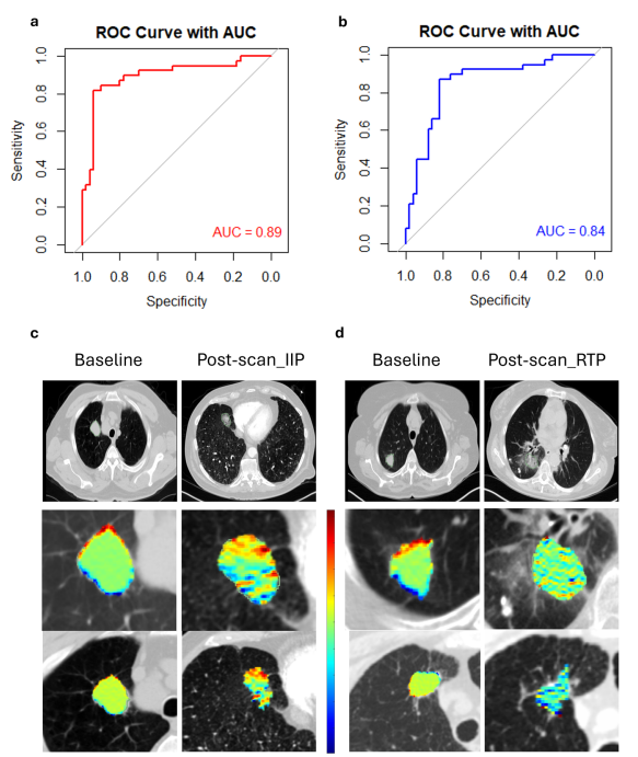 Anant Madabhushi (@anantm) on Twitter photo Thrilled to report paper "Novel radiogenomics approach to predict & characterize pneumonitis in stage III NSCLC" <a href="/Nature_NPJ/">npj Journals</a> Precision Oncology with <a href="/KHigginsMD/">Kristin Higgins</a> <a href="/n8pennell/">Nathan A. Pennell MD, PhD, FASCO</a> <a href="/AmitGupta_83/">Amit Gupta</a> <a href="/vidya555sankar/">Vidya Sankar Viswanathan</a> <a href="/ClevelandClinic/">Cleveland Clinic</a> <a href="/WinshipAtEmory/">Winship Cancer Institute of Emory University</a> <a href="/CityofHopeAtl/">City of Hope</a>
URL: tinyurl.com/3vakx4d3 Thrilled to report paper "Novel radiogenomics approach to predict & characterize pneumonitis in stage III NSCLC" <a href="/Nature_NPJ/">npj Journals</a> Precision Oncology with <a href="/KHigginsMD/">Kristin Higgins</a> <a href="/n8pennell/">Nathan A. Pennell MD, PhD, FASCO</a> <a href="/AmitGupta_83/">Amit Gupta</a> <a href="/vidya555sankar/">Vidya Sankar Viswanathan</a> <a href="/ClevelandClinic/">Cleveland Clinic</a> <a href="/WinshipAtEmory/">Winship Cancer Institute of Emory University</a> <a href="/CityofHopeAtl/">City of Hope</a>
URL: tinyurl.com/3vakx4d3